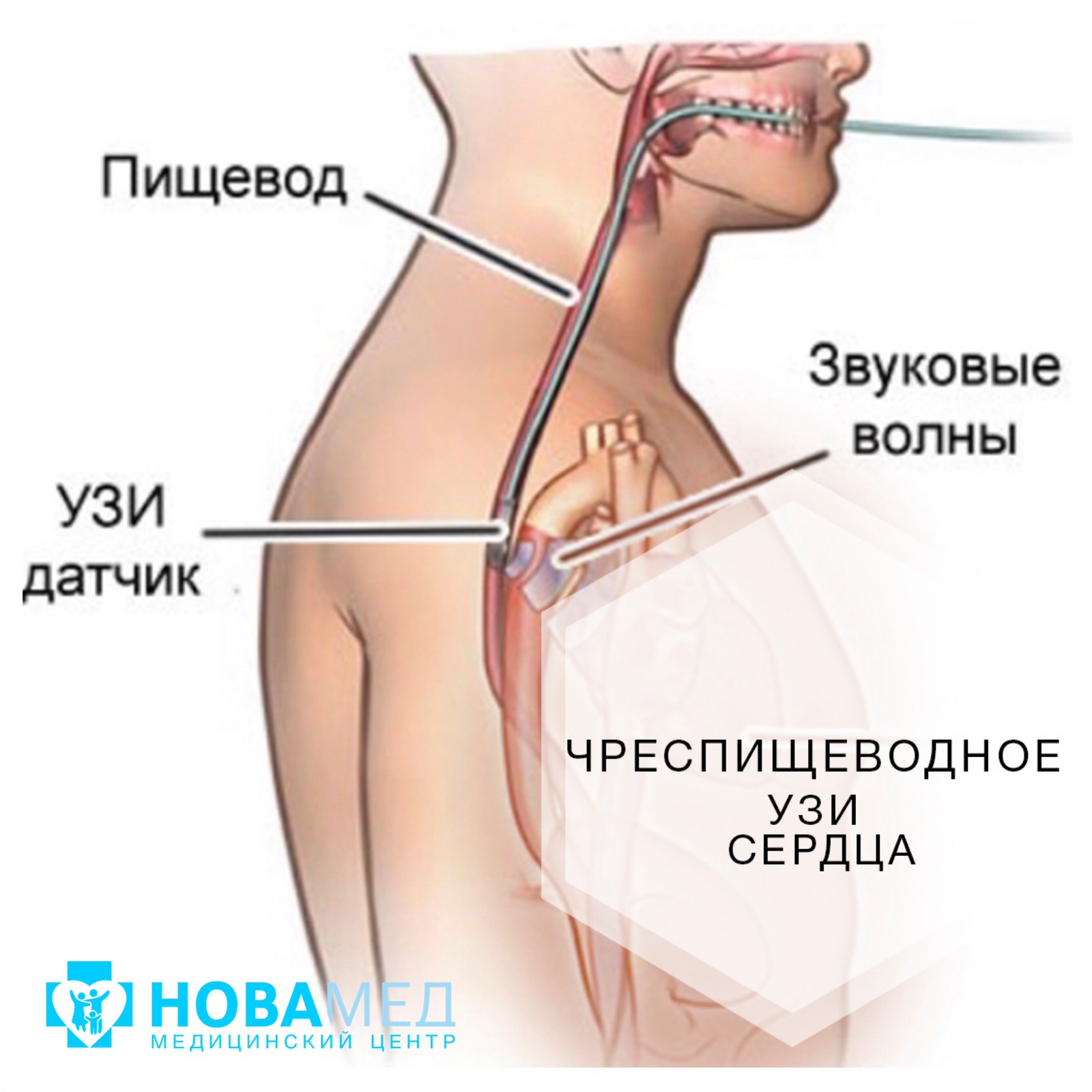 Чреспищеводное УЗИ сердца в Бресте